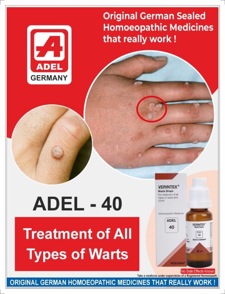 ADEL 40 + 86 - Warts Combination (Internal + External)